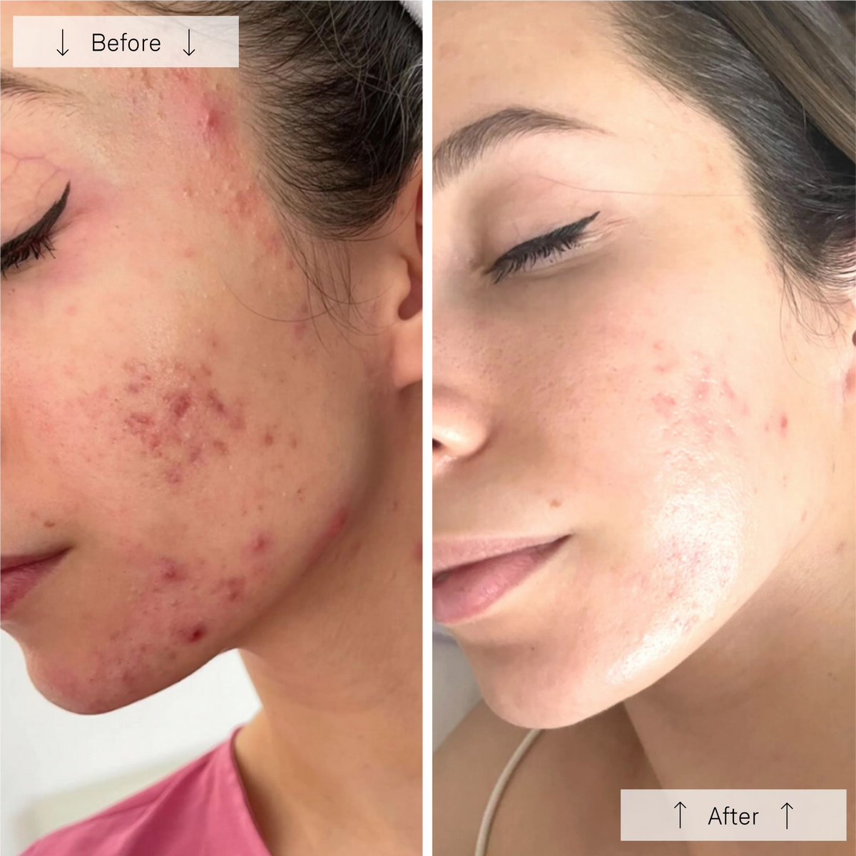 Omnilux Clear + Neck & Décolleté Bundle